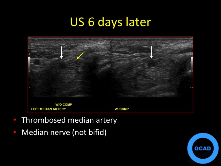 Figure 3 for case thrombus ( RID5037 )